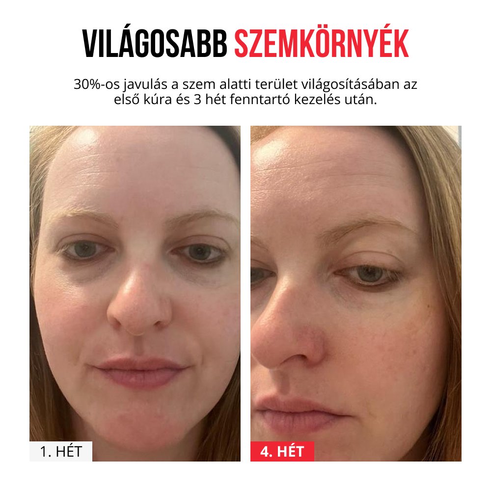Feloldódó mikrotűs tapaszok-kaching