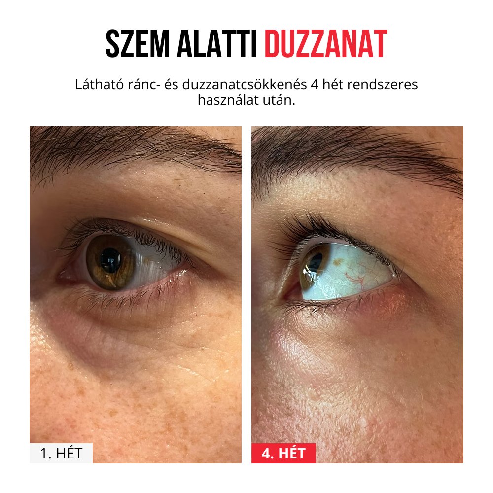 Feloldódó mikrotűs tapaszok-kaching